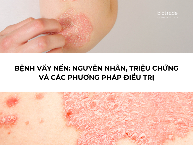 Bệnh Vẩy Nến: Nguyên Nhân, Triệu Chứng, và Các Phương Pháp Điều Trị