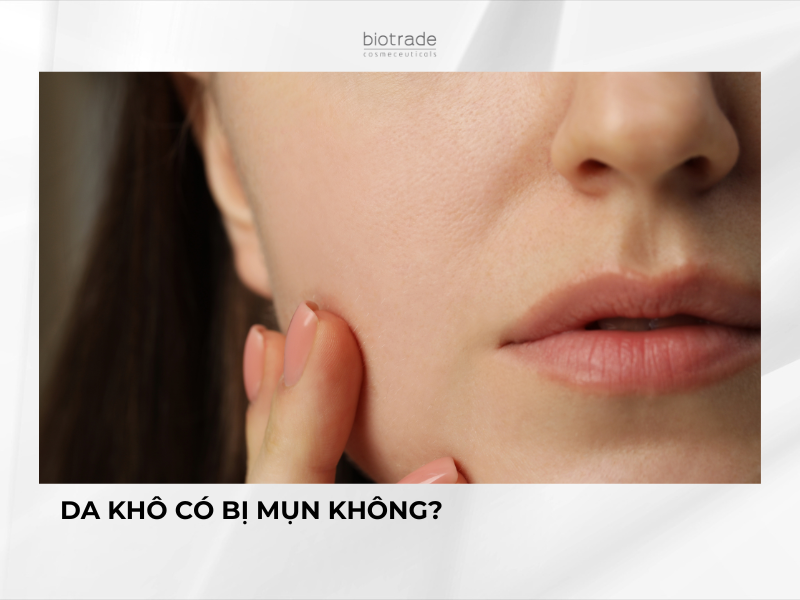 Da Khô Có Bị Mụn Không? Sự Thật Bất Ngờ Về Mối Liên Hệ Giữa Loại Da Và Mụn Trứng Cá