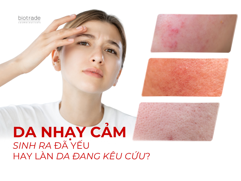 Da nhạy cảm – Sinh ra đã yếu hay làn da đang kêu cứu?