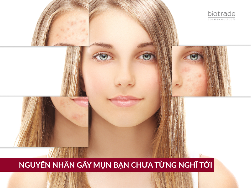 NGUYÊN NHÂN GÂY MỤN BẠN CHƯA TỪNG NGHĨ TỚI