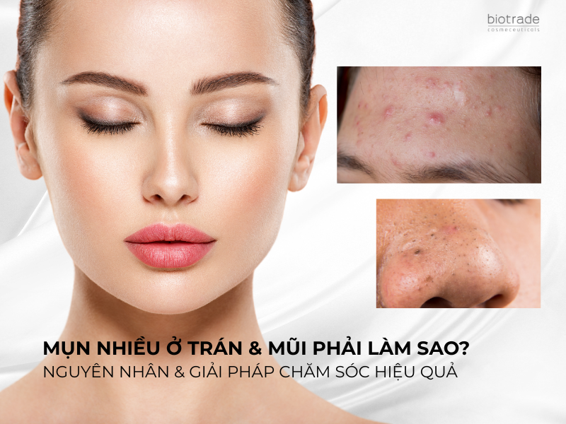 Mụn Nhiều Ở Trán & Mũi Phải Làm Sao? Nguyên Nhân & Giải Pháp Chăm Sóc Hiệu Quả